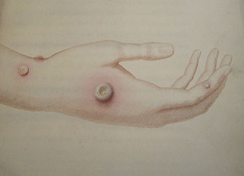 The hand of Sarah Nelmes